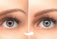 حذف قرمزی چشم